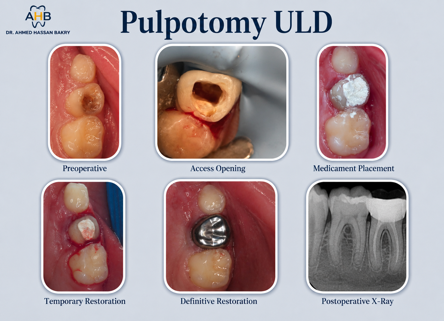Pulpotomy ULD